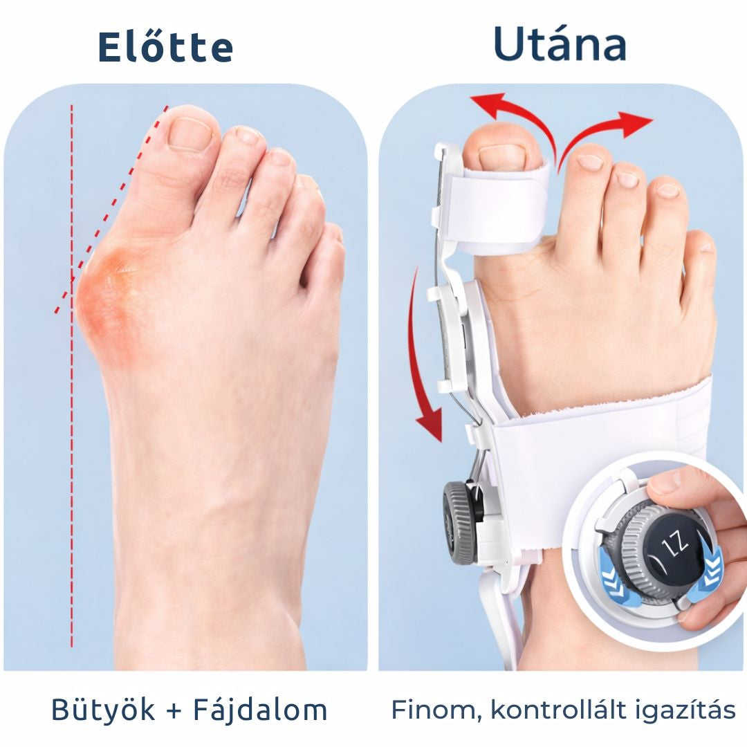 OrthoFlex Éjszakai Bütyök Korrektor